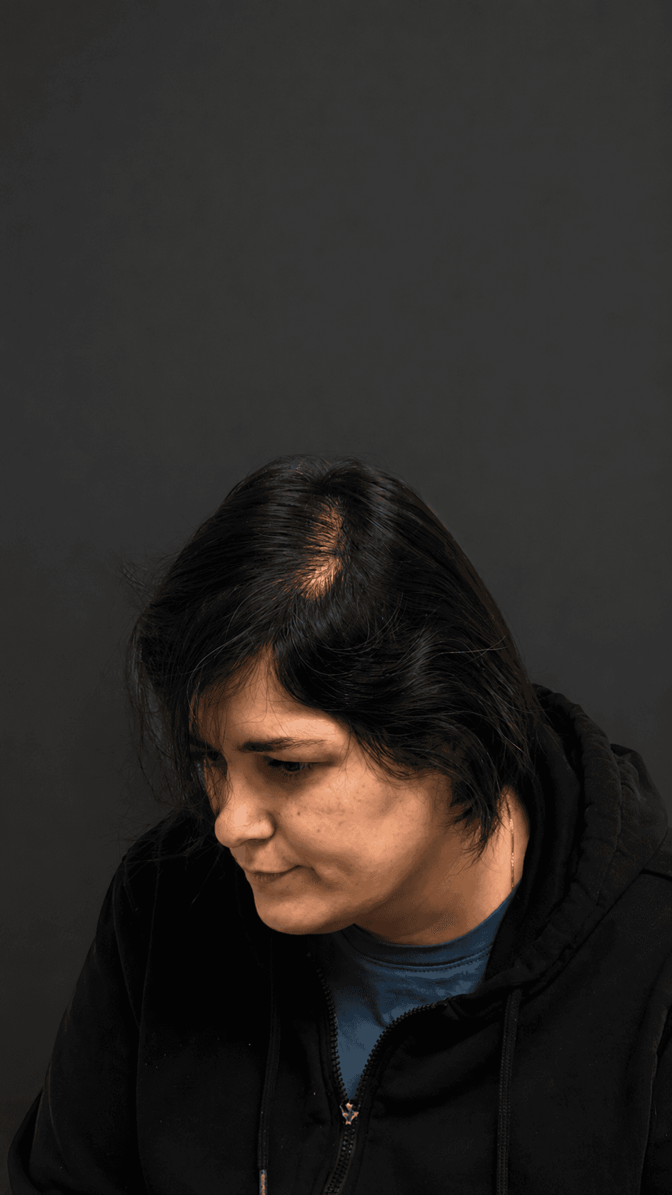 Micropigmentación Capilar — antes