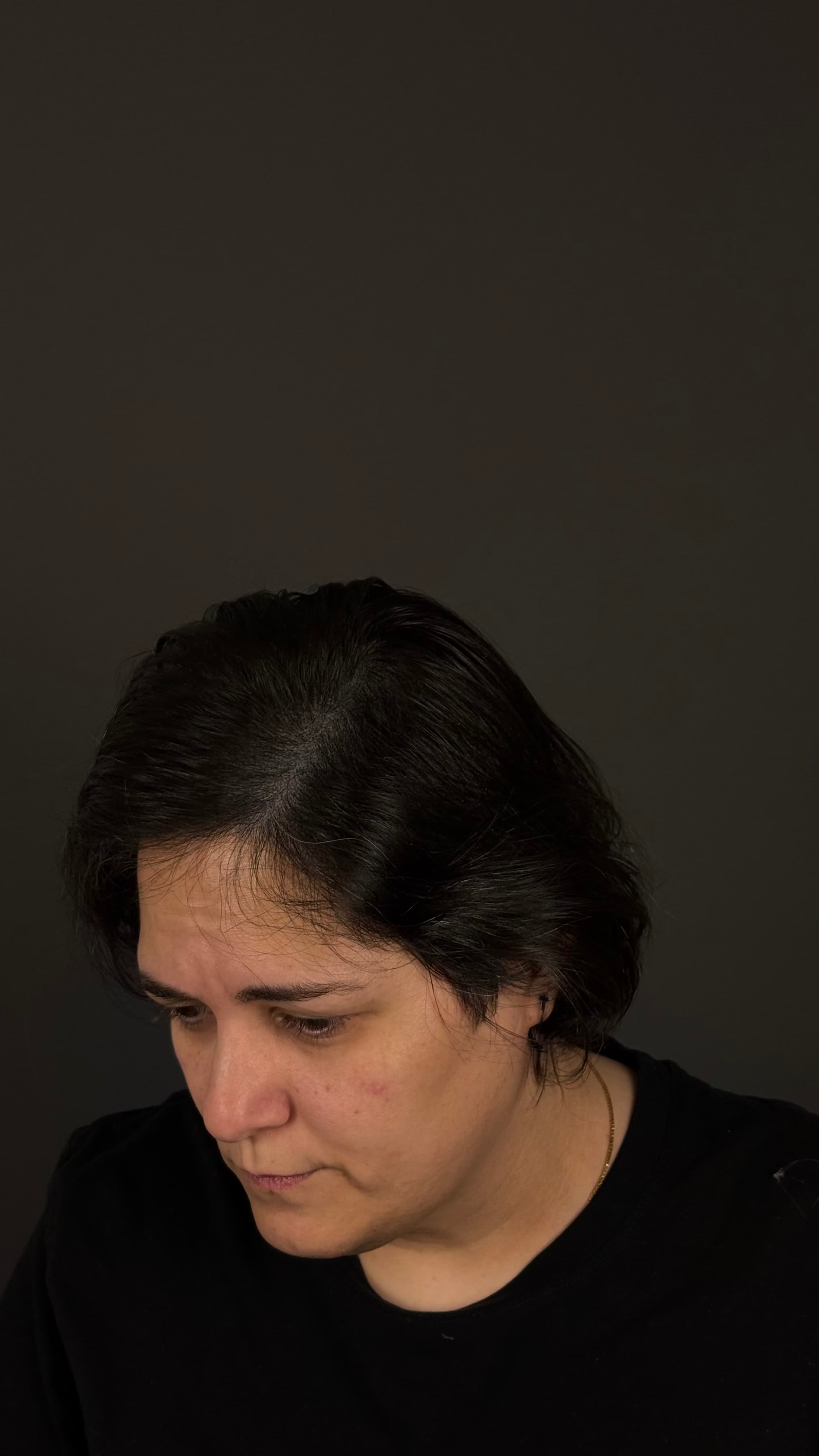Micropigmentación Capilar — después